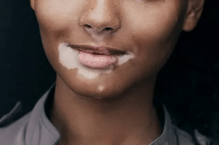 Acrofacial Vitiligo