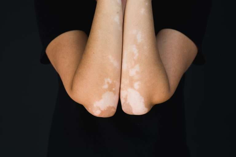 GeneraLIZED vITILIGO