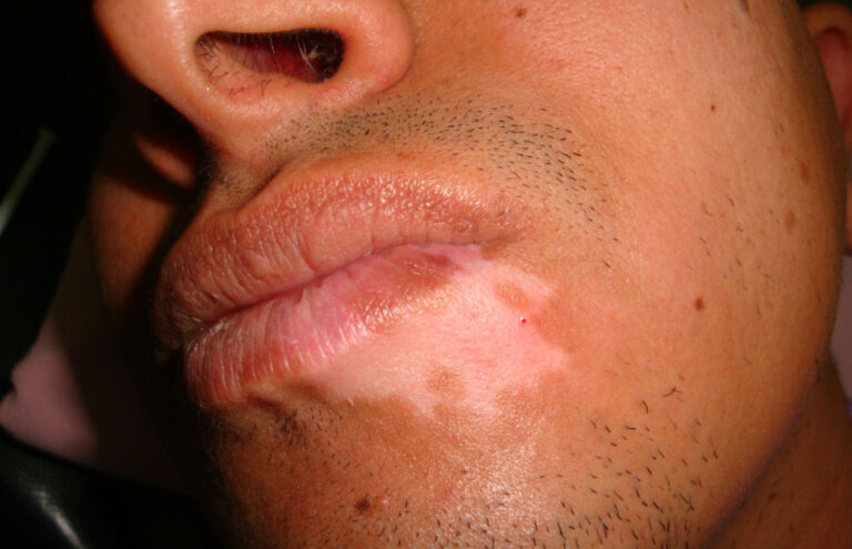 Focal-vitiligo