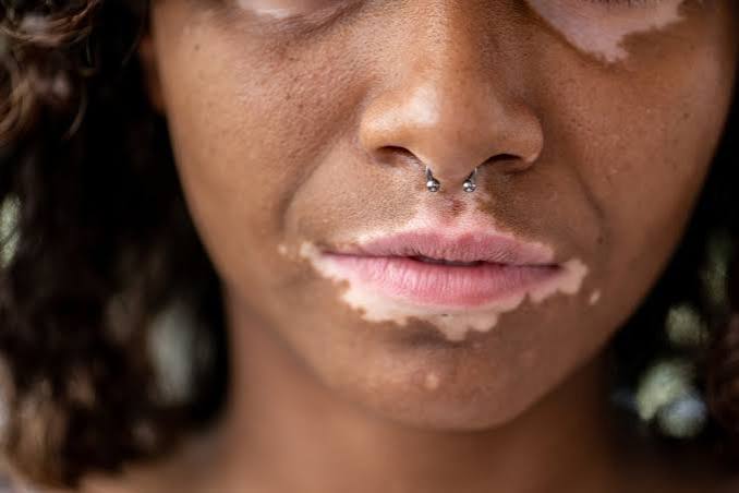 non segmental vitiligo