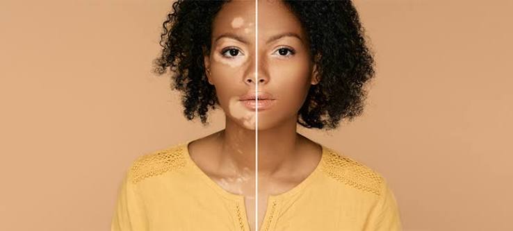 segmental vitiligo