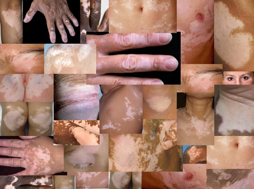 VITLIGO